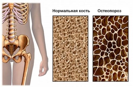 Причини, симптоми и мерки за предотвратяване на дифузна остеопороза на гръбначния стълб