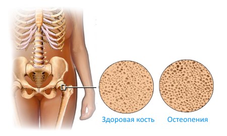 Остеопения на гръбначния стълб - симптоми, признаци, лечение и прогноза в случай на заболяване