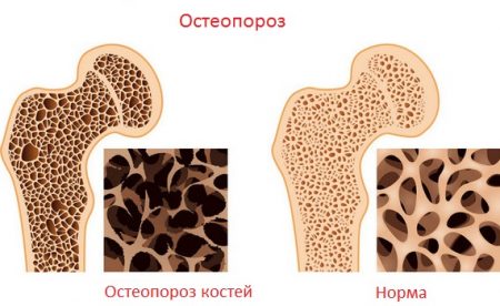 Остеопороза при жените - причини, симптоми, диагноза, лечение