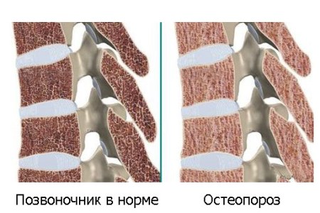 Симптоми и лечение на остеопороза на цервикалния и лумбосакралния гръбнак