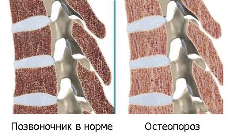 Симптоми и лечение на педиатричната остеопороза