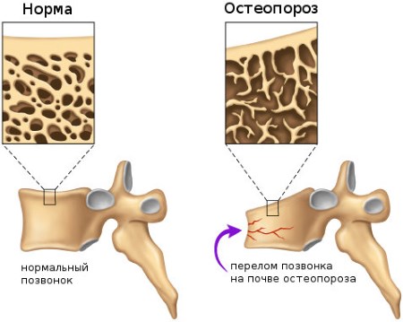 Симптоми, причини и лечение на остеопороза