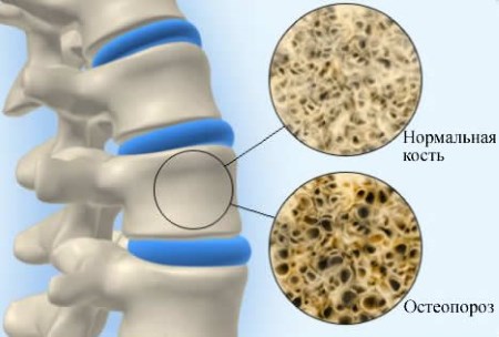Симптоми, причини и лечение на остеопороза