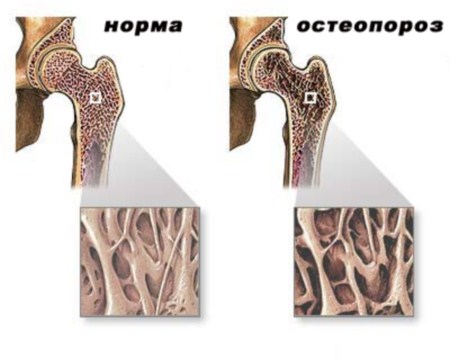 Симптоми, ранни признаци и лечение на остеопороза на тазобедрената става