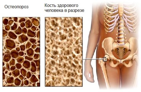 Симптоми, лечение и методи за диагностициране на остеопороза на костите