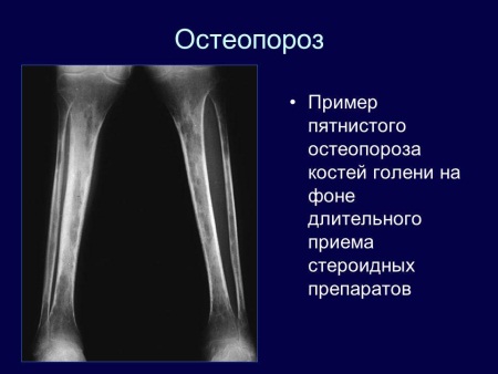 Какво е забелязана остеопороза и какви са нейните характеристики