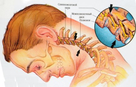 Остеохондроза на гръбнака с радикуларен синдром - симптоми и лечение