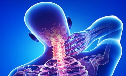 Какви са остеофитите на шийния гръбнач на човека и как да се отървете от тях?