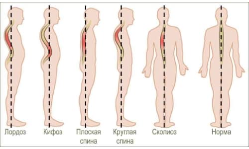 Какво представлява дорсопатията на гръбначния стълб, кода на МКБ-10, какви са неговите симптоми и лечение?