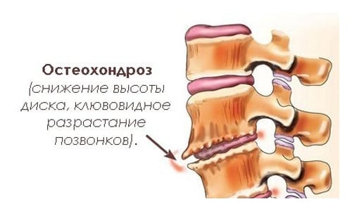 Причини, симптоми и методи на лечение на дорзопатия на гръдния кош