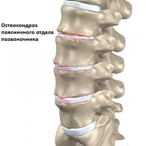 Болки в гърба - симптоми от долната част