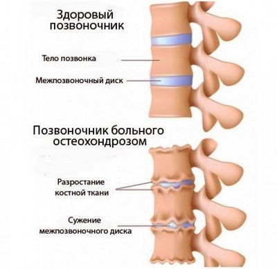 Болка в гърба при остеохондроза