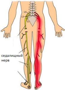 Лумбална спондилоза на фона на сколиоза, болки в бедрата и долната част на крака