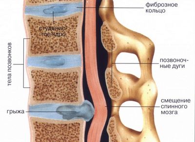 Причини за херния в лумбалния гръбначен стълб