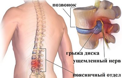 Народни средства за лечение на херния на лумбалния гръбнак