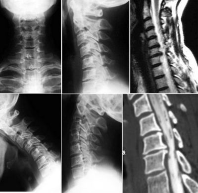 Остеохондроза на цервикалната и лумбалната част на гръбначния стълб
