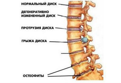 Остеохондроза на цервикалната и лумбалната част на гръбначния стълб