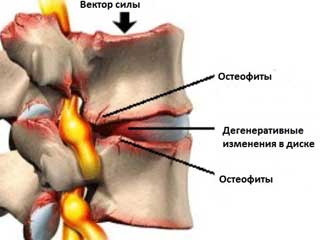 Гърб на гръбнака в лумбалния гръбначен стълб