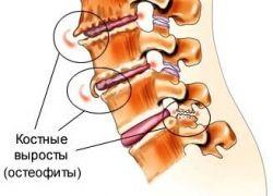 Гърб на гръбнака в лумбалния гръбначен стълб