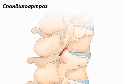 Спондилоза и спондилартроза на лумбалния гръбначен стълб