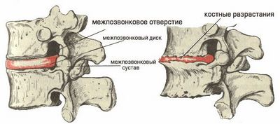Spondylosis на лумбалния гръбнак е