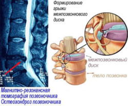 Синдроми при остеохондроза на лумбалния участък