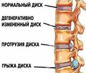 Проток на гръбначния стълб на лумбалния гръбнак как да се лекува това, което е