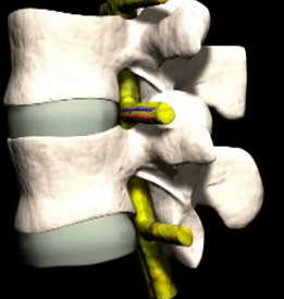 Лечение на остеохондрозна лумбосакрална гръбнака преглед