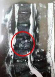 Тумор в лумбалния гръбначен стълб