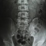Рентгеновият анализ на лумбалния сакрален гръбнак