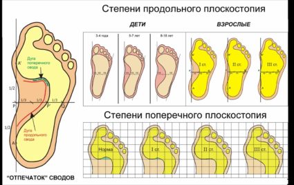 Причини и степени на надлъжно развитие на плоските стъпала