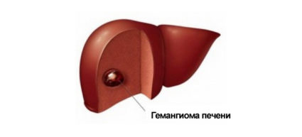 Причини и методи за лечение на хемоангиома на черния дроб