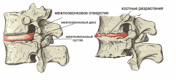 Uncovertebral артроза на шийката на гръбначния стълб: симптоми и лечение