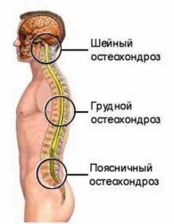 Остеохондрозата на гръбначния стълб: как се случва, симптомите и лечението