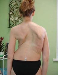 Сколиоза на гръбнака: симптоми, признаци и лечение