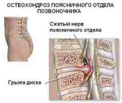 Лечение на остеохондрозата на цервикалния гръбначен стълб