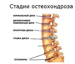 Лечение на остеохондрозата на цервикалния гръбначен стълб