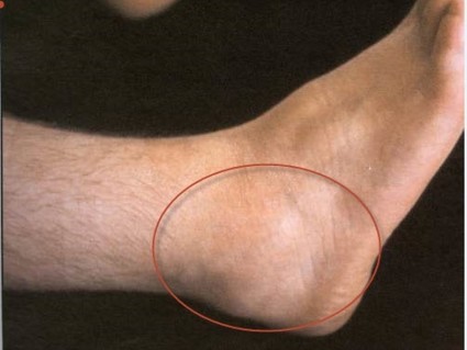Бурсит на краката: видовете болести, причините за тях и начините на лечение
