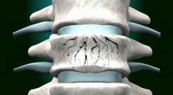 Хемангиом на гръбнака: причини, симптоми и методи на лечение