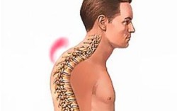 Кфиоза в гръдния кош: причини, симптоми и лечение