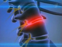 Прострукция на дисковете на лумбалната част на гръбначния стълб: симптоми, етапи и лечение