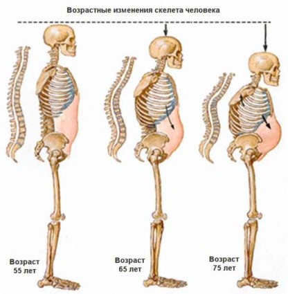 Остеопороза - симптоми и лечение на костни заболявания