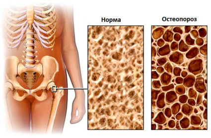 Остеопорозата. Причини, симптоми и признаци, както и превенция