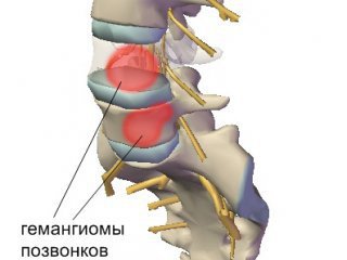 Симптоми и лечение на гръбначния хемангиом