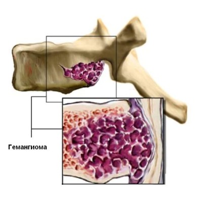 Симптоми и лечение на хемангиома на гръбначния стълб