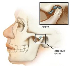 Temporomandibular joint: неговата структура, функции и заболявания