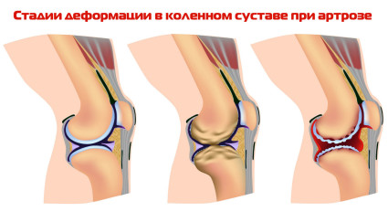 Артроза на колената - заболяване, изискващо незабавно лечение