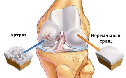 Артроза на колената - заболяване, изискващо незабавно лечение