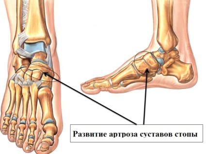 Съчленена патология на краката и дали е възможно да се отървете от нея