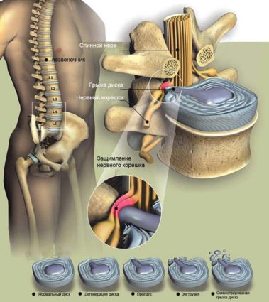 Причини и клинична картина на херния в различни части на гърба